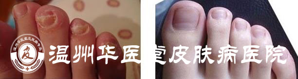 华医堂治疗灰指甲