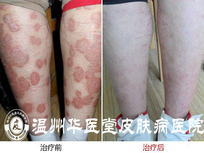 温州华医堂治疗牛皮癣