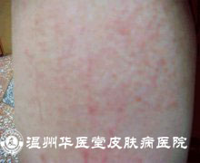 温州华医堂治疗湿疹