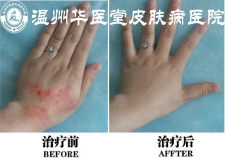 温州华医堂治疗荨麻疹