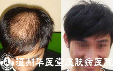 温州华医堂治疗脱发