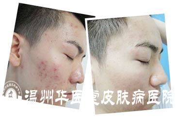 温州华医堂治疗青春痘