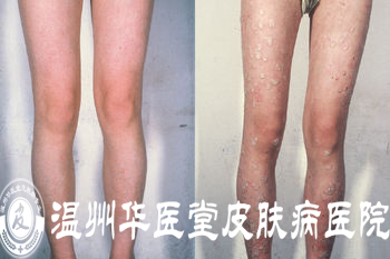 温州华医堂治疗牛皮癣