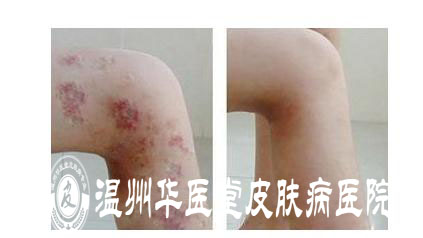 温州华医堂治疗湿疹
