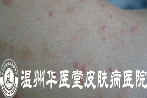 温州华医堂治疗毛囊炎
