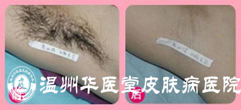 温州华医堂治疗腋臭