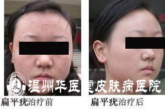 扁平疣的传播途径有哪些