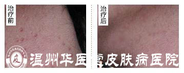<a href='http://www.jinghedesign.com/' target='_blank' title='温州华医堂皮肤病医院'><span style='color: #0000ff'><strong>温州华医堂皮肤病医院</strong></span></a>毛囊炎图片