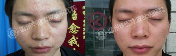 怎样引起青春痘的出现