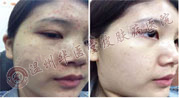 <a href='http://www.jinghedesign.com/' target='_blank' title='温州华医堂皮肤病医院'><span style='color: #0000ff'><strong>温州华医堂皮肤病医院</strong></span></a>青春痘图片