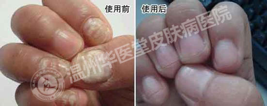 灰指甲初期有何症状表现