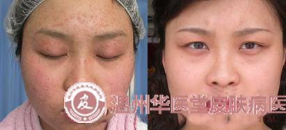 <a href='http://www.jinghedesign.com/' target='_blank' title='温州华医堂皮肤病医院'><span style='color: #0000ff'><strong>温州华医堂皮肤病医院</strong></span></a>扁平疣图片