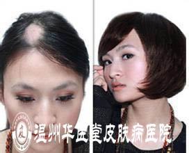 <a href='http://www.jinghedesign.com/' target='_blank' title='温州华医堂皮肤病医院'><span style='color: #0000ff'><strong>温州华医堂皮肤病医院</strong></span></a>斑秃图片