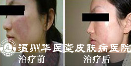 治疗过敏性皮炎要注意哪些