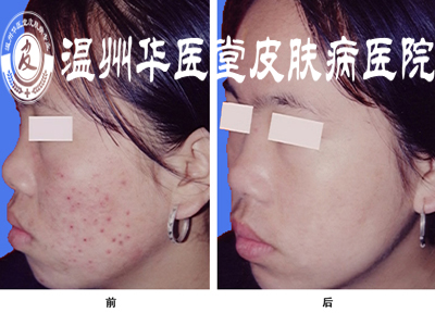 长了青春痘要注意哪些