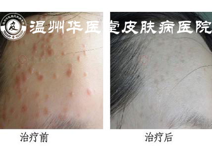 防止扁平疣反复发作要怎么做