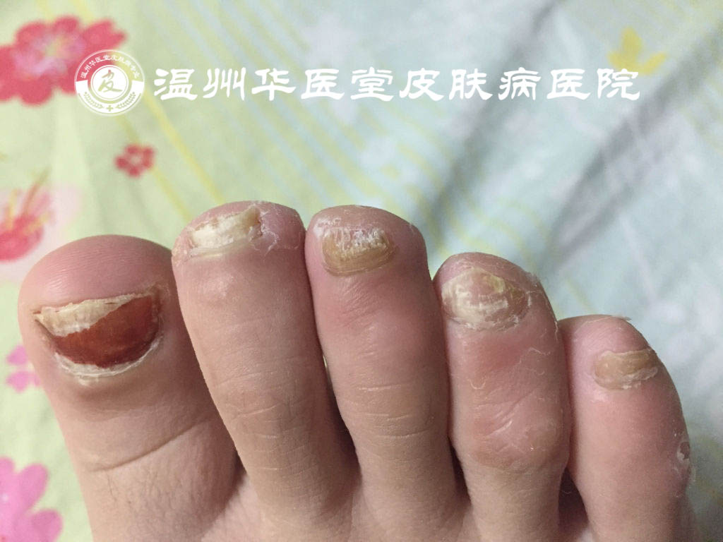 患上灰指甲会出现哪些症状