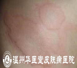 荨麻疹的症状特点