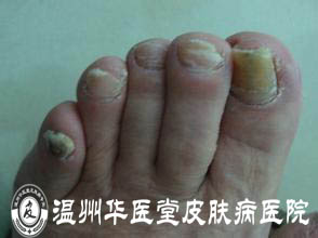 灰指甲病发初期时的症状