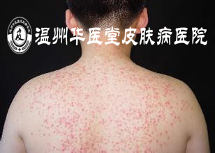 毛囊炎的症状有哪些