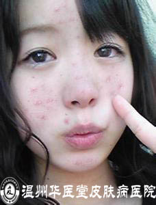 青春痘的症状是怎样的