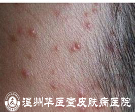 胡须毛囊炎