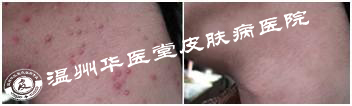 胡须毛囊炎