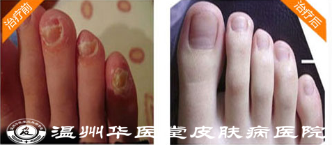 灰指甲