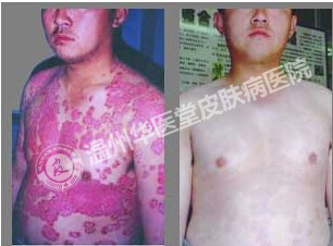 牛皮癣