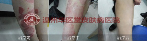 牛皮癣