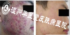 痤疮预防