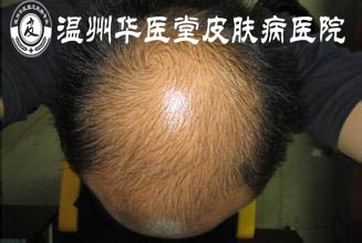 脂溢性脱发的症状